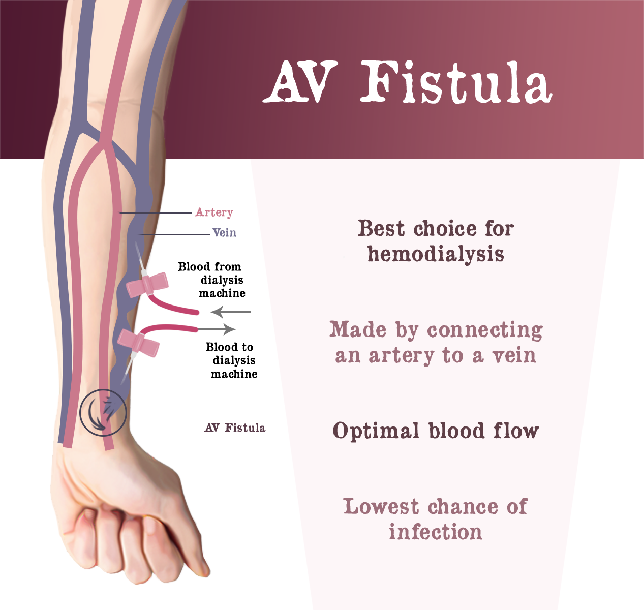 Hemodialysis Access Gaytri Manek Formerly Gandotra MD